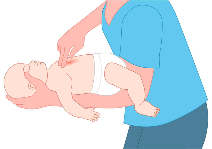Illustration of a baby lying face up along a rescuer's forearm receiving chest thrusts with two fingers