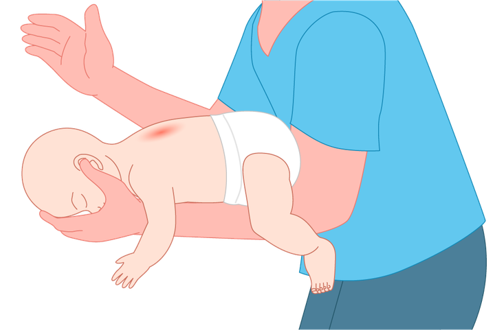 Illustration of a baby lying face down along a rescuer's forearm receiving back blows between the shoulder blades