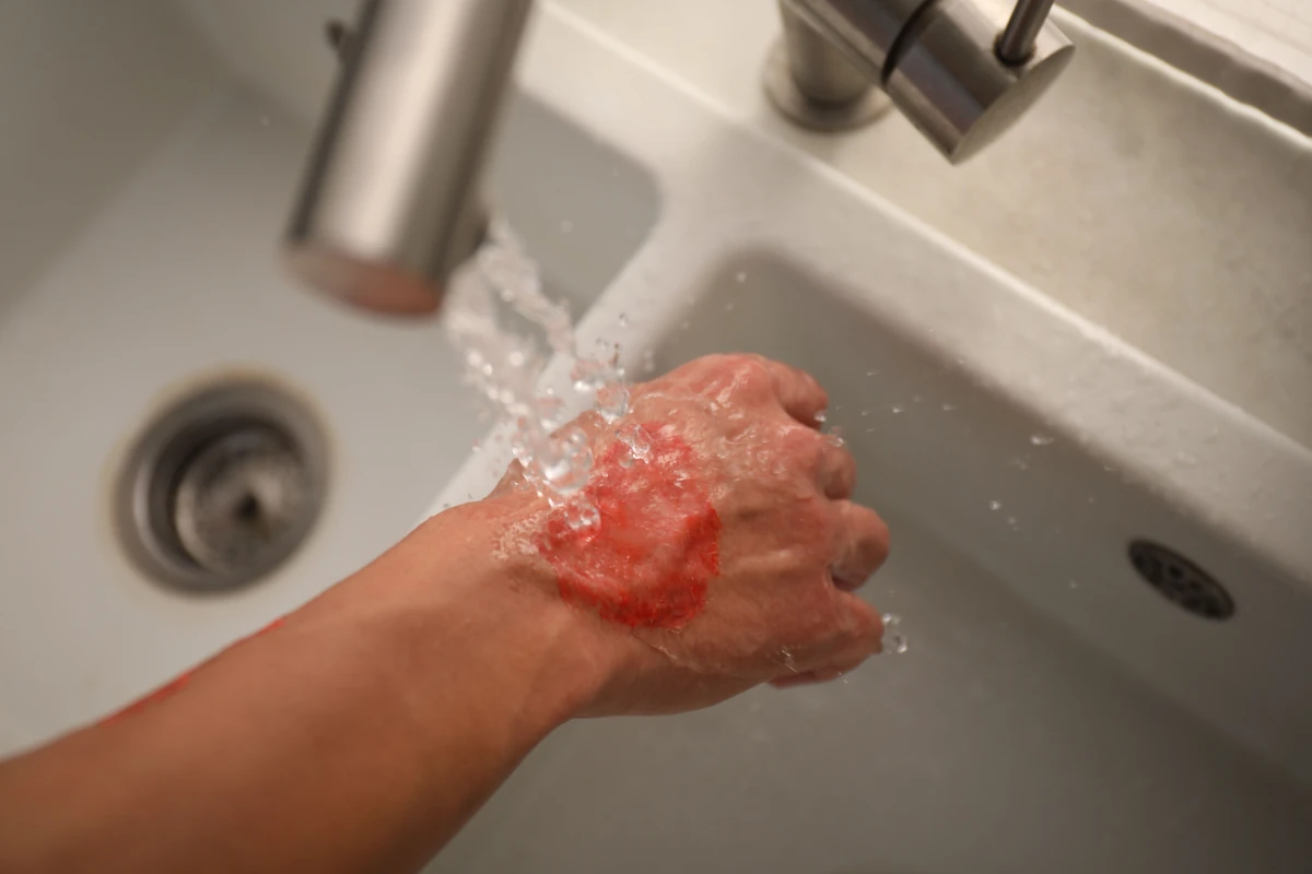 Hand with a minor burn held under cool running water at a kitchen sink